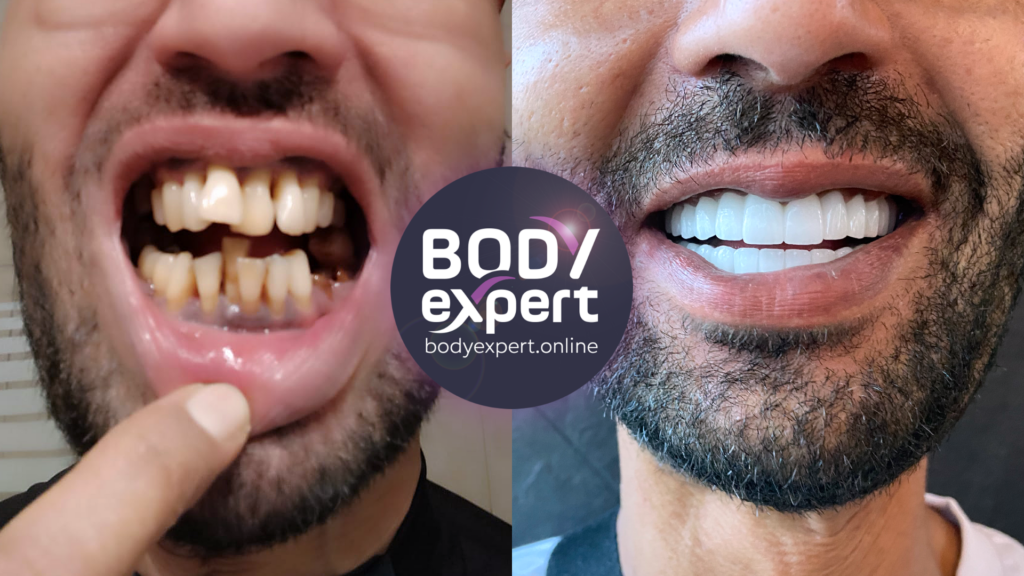 Impressive result of a global rehabilitation using the All-on-6 technique, before and after photos illustrating the metamorphosis of the dentition.