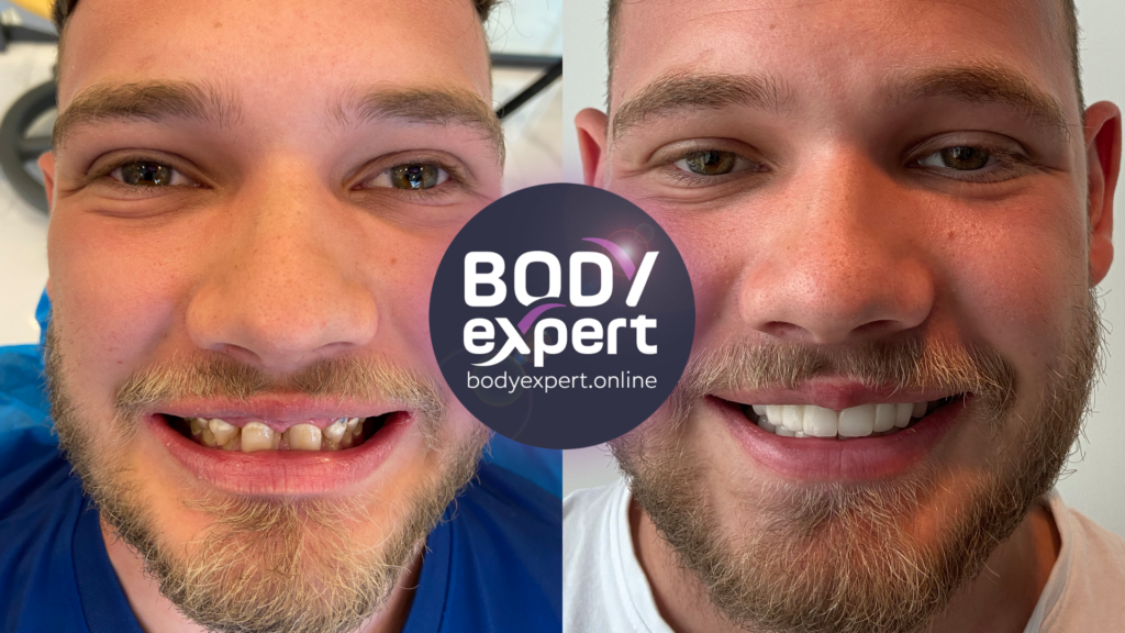 Remarkable smile transformation thanks to dental crowns and gummy smile treatment, illustrated by before and after pictures.