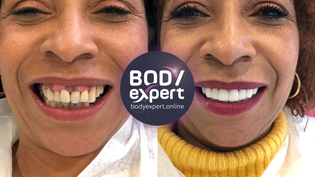 Spectacular result of dental crowns combined with a gummy smile treatment, before and after photos testifying to the metamorphosis of the smile.