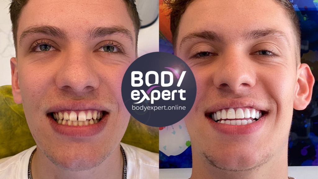 Résultat de facettes dentaires associées à une correction du sourire gingival, photos avant et après pour apprécier l'harmonie retrouvée du sourire.