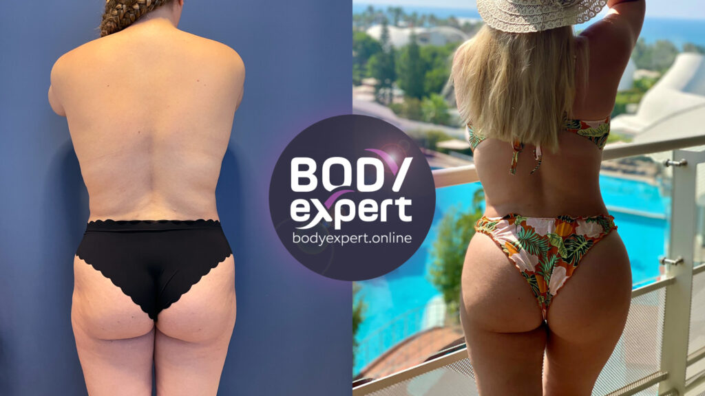Before-after of a buttock fat transfer preceded by liposuction, emphasizing the harmonious transfer of fat to augment and shape the buttocks.