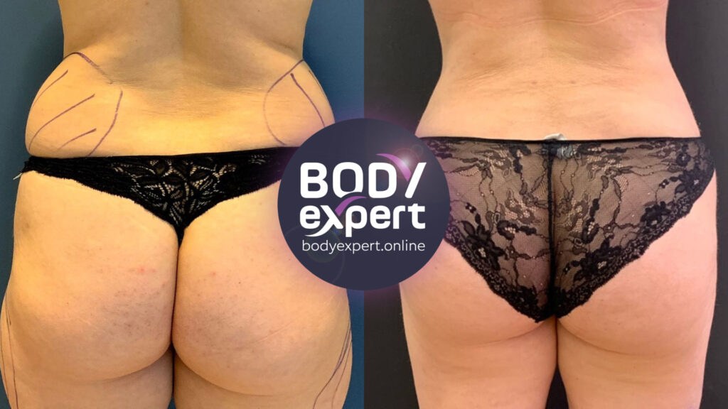 Spectacular body transformation thanks to liposuction followed by BBL, illustrated by before and after images of the procedure.