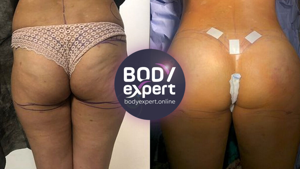 Before-after comparison of a liposculpture with fat transfer to the buttocks to reshape curves and enhance the contours.