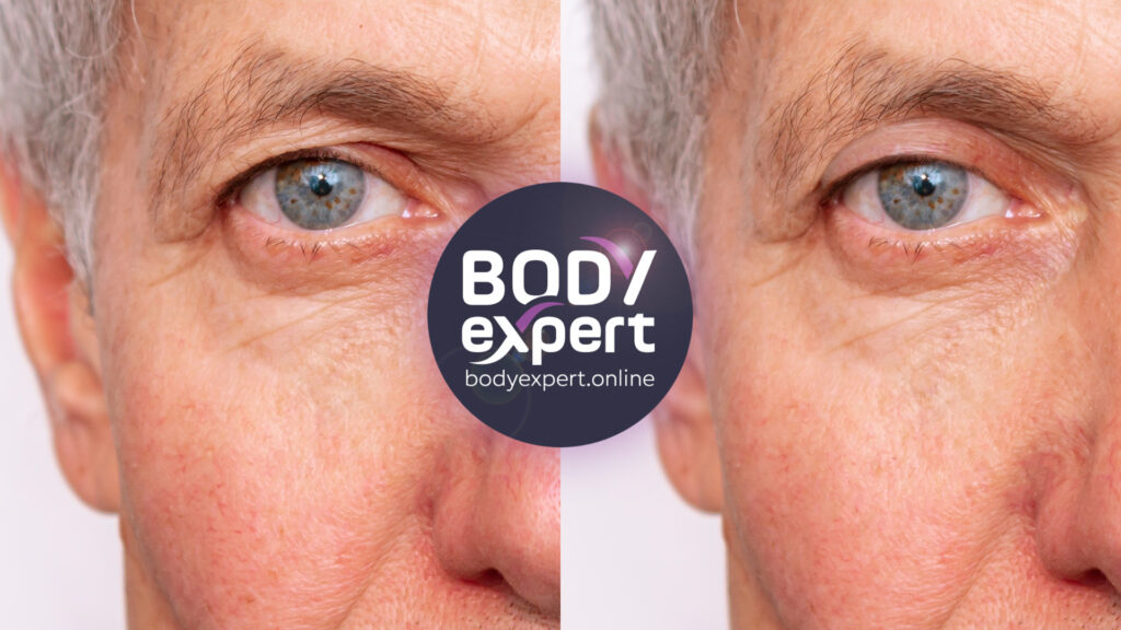 Before and after photos of an upper blepharoplasty, revealing refreshed eyes and enhanced eyes.