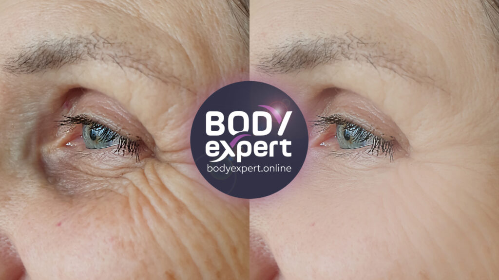 Before-after comparison of a lower blepharoplasty to reduce under-eye bags and rejuvenate the eyes.