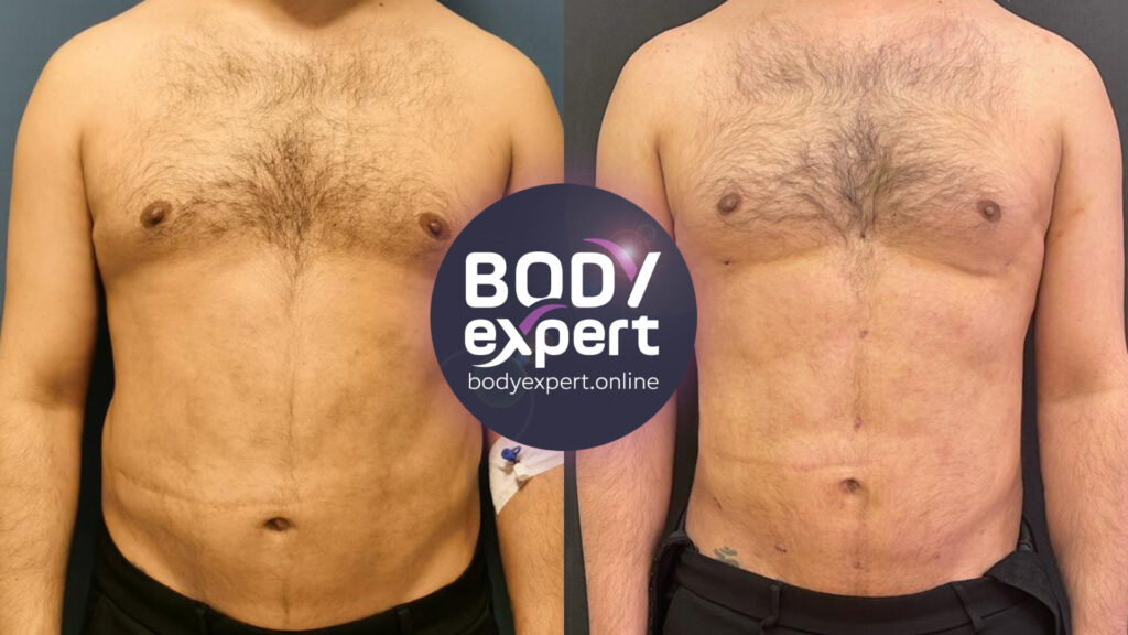 Before-after of a liposuction to remove localized fat and refine body contours.