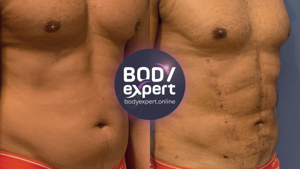 Result of a targeted liposuction to reveal