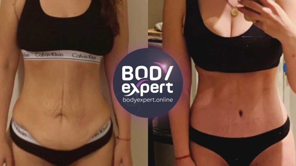 Before-after comparison of a tummy tuck to tighten abdominal skin and restore a flat, toned stomach.