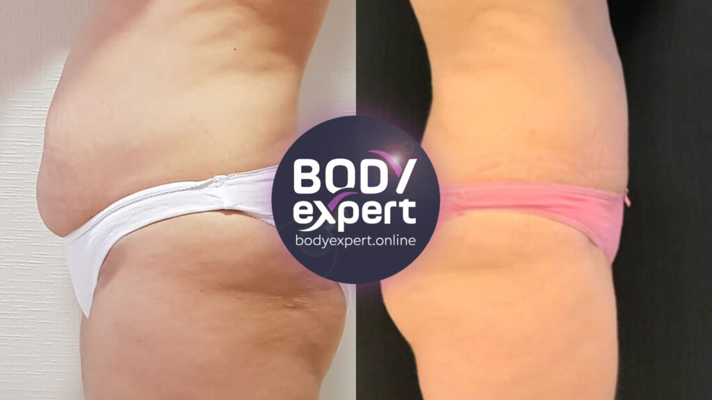 Before-after of liposuction and tummy tuck to sculpt the stomach and refine the waist.