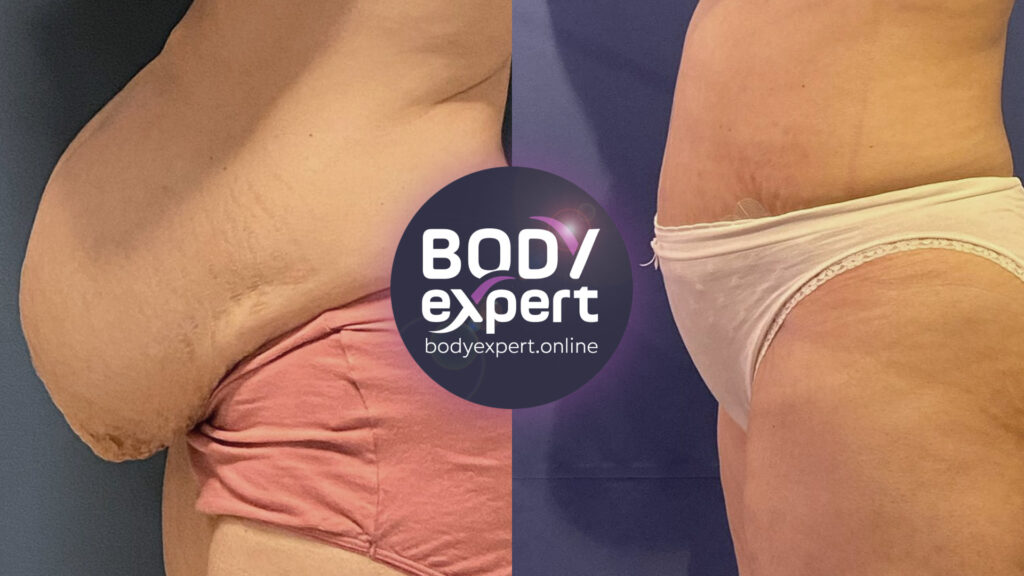 Photos avant et après une lipoaspiration associée à un mini-lifting abdominal, révélant un ventre plus plat et une silhouette affinée.