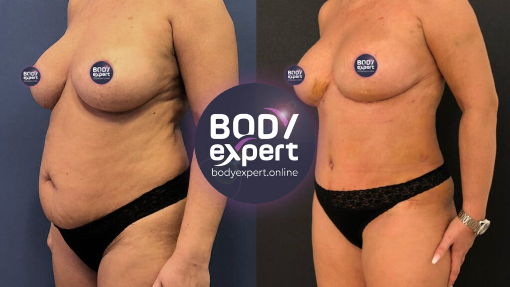 Impressive abdomen transformation thanks to a lipo-abdominoplasty, illustrated by before and after pictures of the surgical procedure.