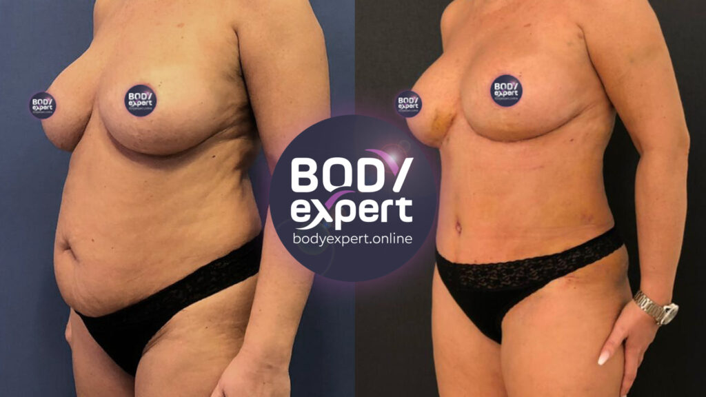 Transformation impressionnante de l'abdomen grâce à une lipo-abdominoplastie, illustrée par des clichés avant et après l'intervention chirurgicale.