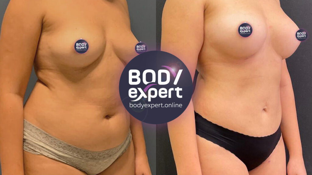 Before-after comparison of a gentle liposuction followed by a tightening of the abdominal wall for a firmer, more toned stomach.