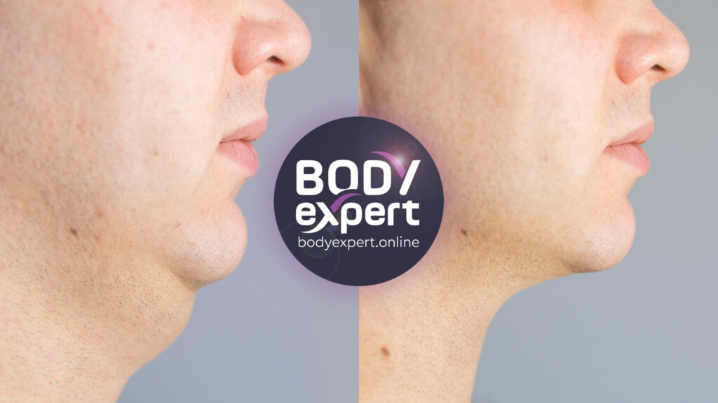 Before and after photos of a cervical liposuction, showing a slimmer neck and a sharper profile.