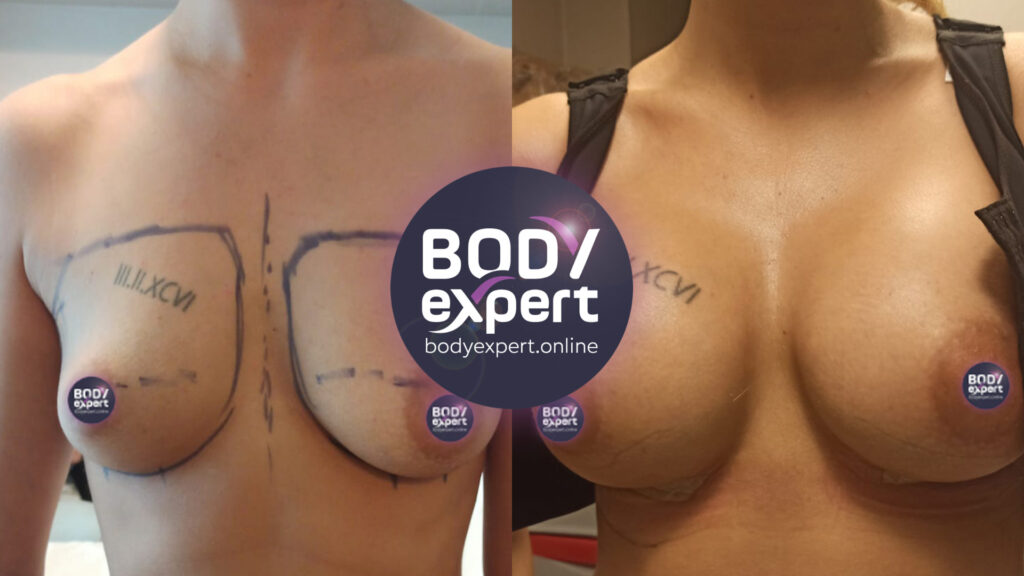 Before-after comparison of a breast lift combined with an augmentation of breast volume to improve the shape and size of the bust.