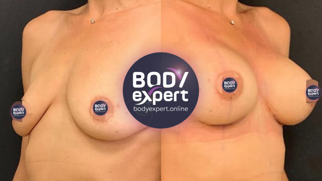 Résultat d'une chirurgie de lifting et d'augmentation mammaire, photos avant et après l'intervention pour mettre en valeur la transformation de la silhouette.