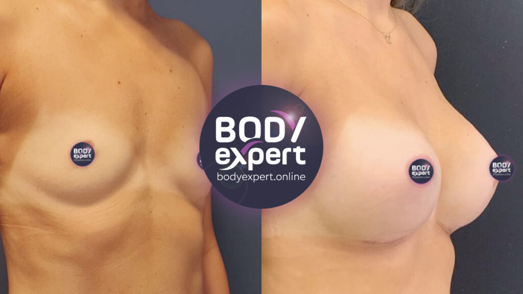 Photos avant et après un lifting mammaire avec pose d'implants, révélant des seins plus volumineux, symétriques et esthétiques.