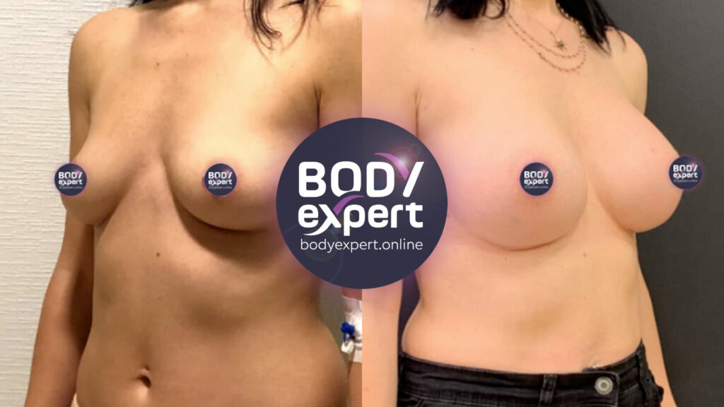 Transformation de la poitrine grâce à un lifting et une augmentation mammaire, illustrée par des images avant et après la chirurgie plastique.