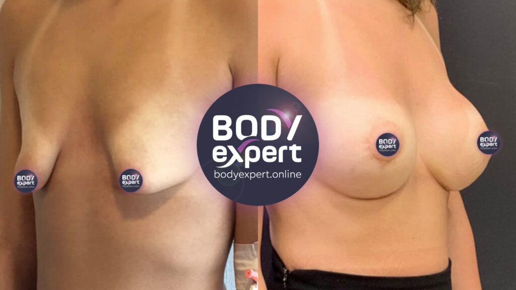 Before-after comparison of an augmentation mammoplasty combined with a lift to lift and enlarge the breasts.