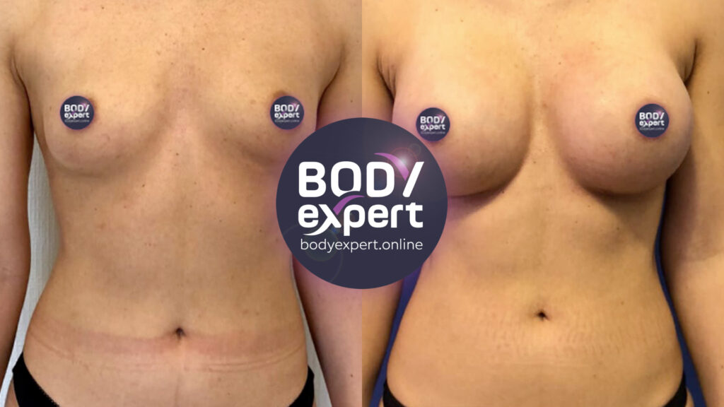 Result of a breast lift and augmentation surgery, before and after photos to appreciate the change in volume and positioning of the breasts.