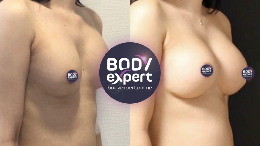 Before and after photos of a breast lift procedure with implants, for shapelier, younger-looking, and harmonious breasts.