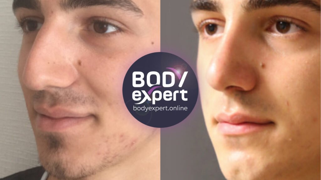 Comparaison avant-après d'une rhinoplastie pour corriger la forme du nez et améliorer l'harmonie du visage.