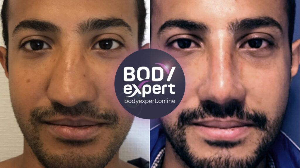 Transformation du profil par une rhinoplastie, illustrée par des clichés avant et après l'intervention chirurgicale.