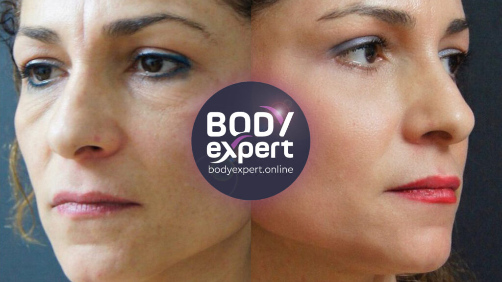 Result of a neck and face lift, before and after photos to appreciate the overall facial rejuvenation.