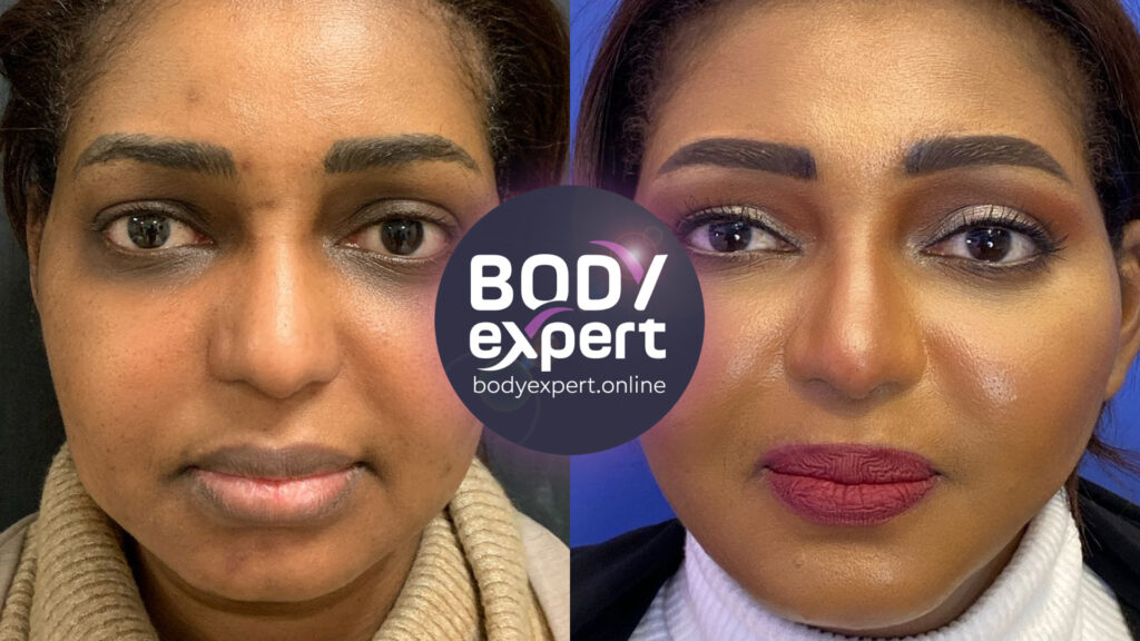 Avant-après d'une chirurgie du visage complète incluant lifting, blépharoplastie et lipofilling, pour un résultat naturel et harmonieux.