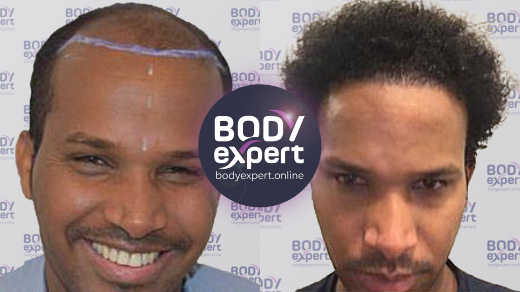 Before-after of an FUE transplant of 3200 grafts for an afro patient, result at 1 year.