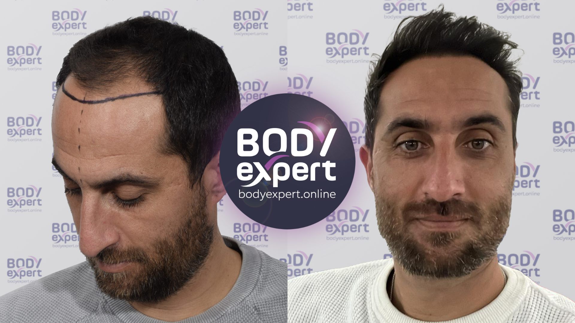 DHI hair transplant for Olivier, with 2500 grafts implanted. Photos before and 10 months after the operation.