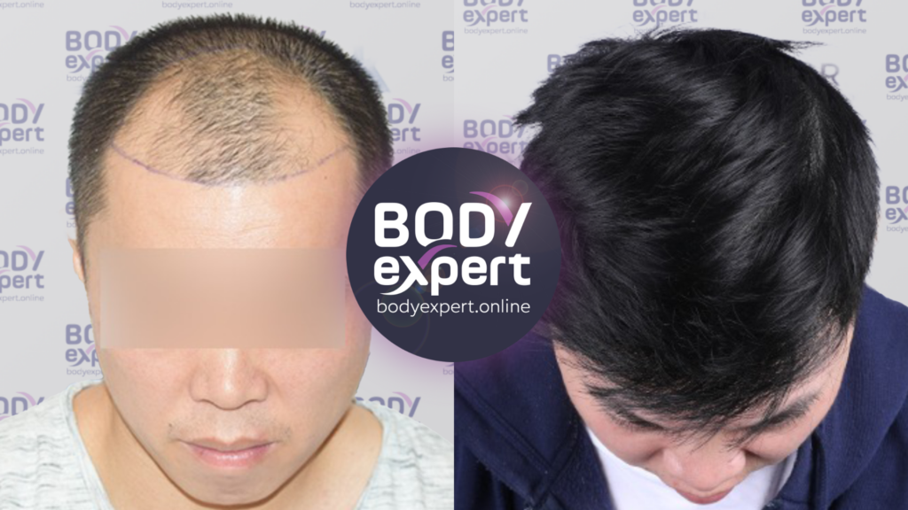 FUE hair transplant with 3500 grafts implanted, photos before and 1 year after the operation.