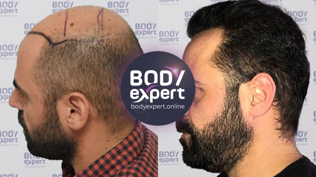 Result 18 months after an FUE transplant of 4100 grafts.