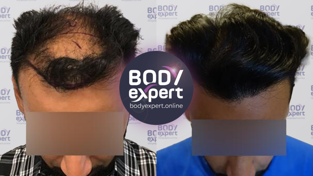 Before-after comparison of an FUE transplant of 4300 grafts, result at 1 year.