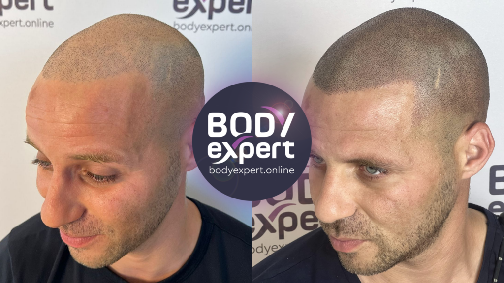 Before-after comparison of a scalp micropigmentation to conceal hair loss and recreate the illusion of a thicker head of hair.