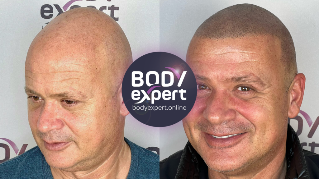 Before-after of a scalp micropigmentation for a natural and aesthetic shaved effect on a man suffering from baldness.