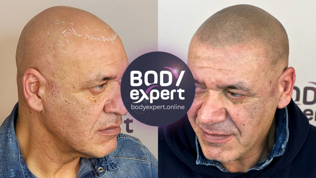Before and after photos of a hair micropigmentation, revealing a stylish and confident look despite pronounced hair loss.