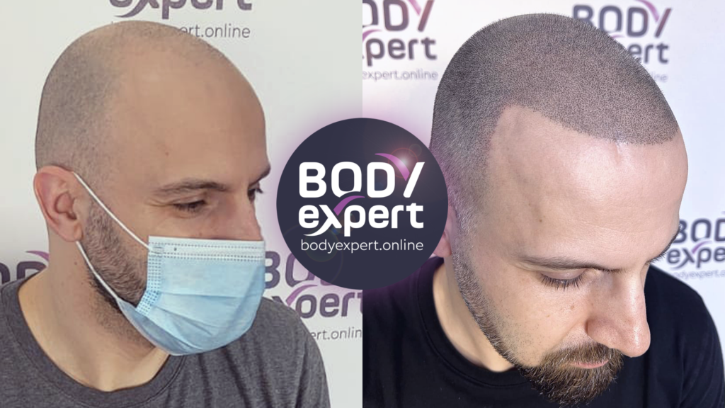 Surprising scalp transformation thanks to micropigmentation, illustrated by before and after pictures of the treatment.