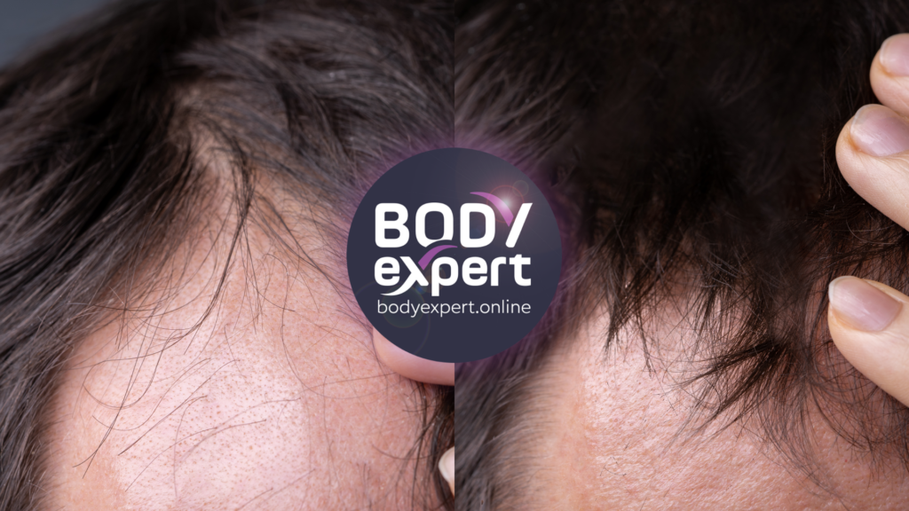 Comparaison avant-après d'un traitement laser capillaire pour stimuler la repousse des cheveux et réduire la perte de densité.