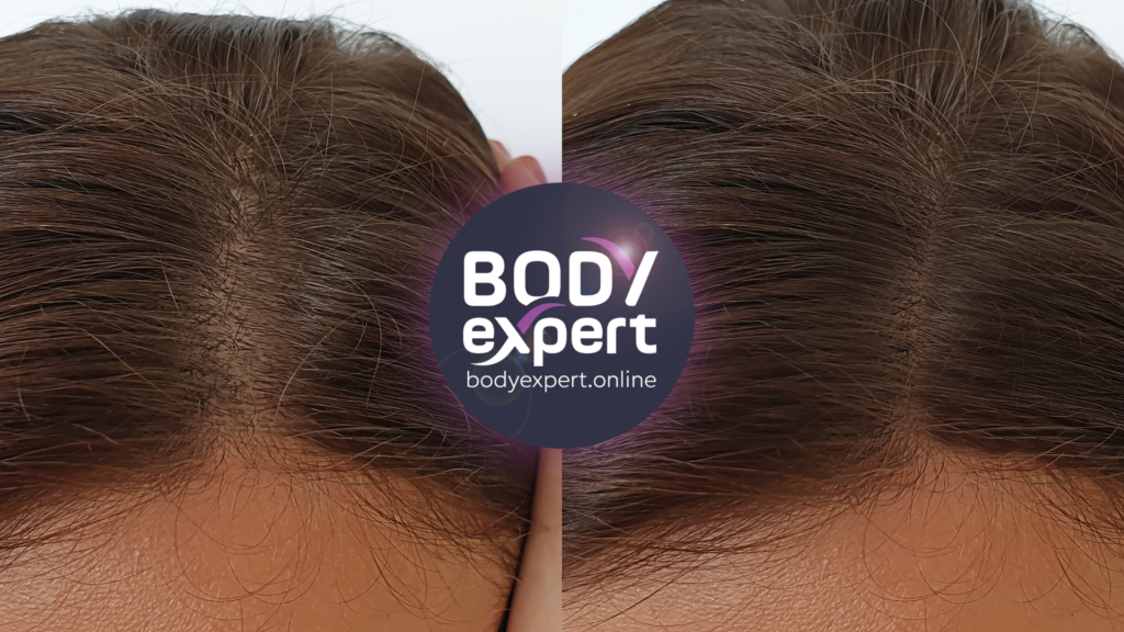 Photos avant et après un traitement laser capillaire, révélant des cheveux plus épais et plus résistants.