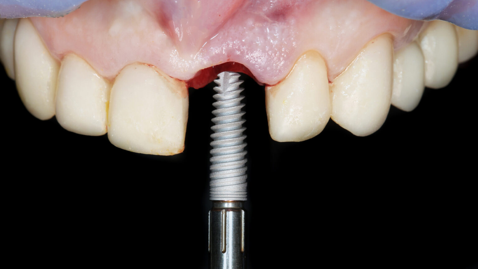 Implant dentaire risques quels sont le risques et complications — free download