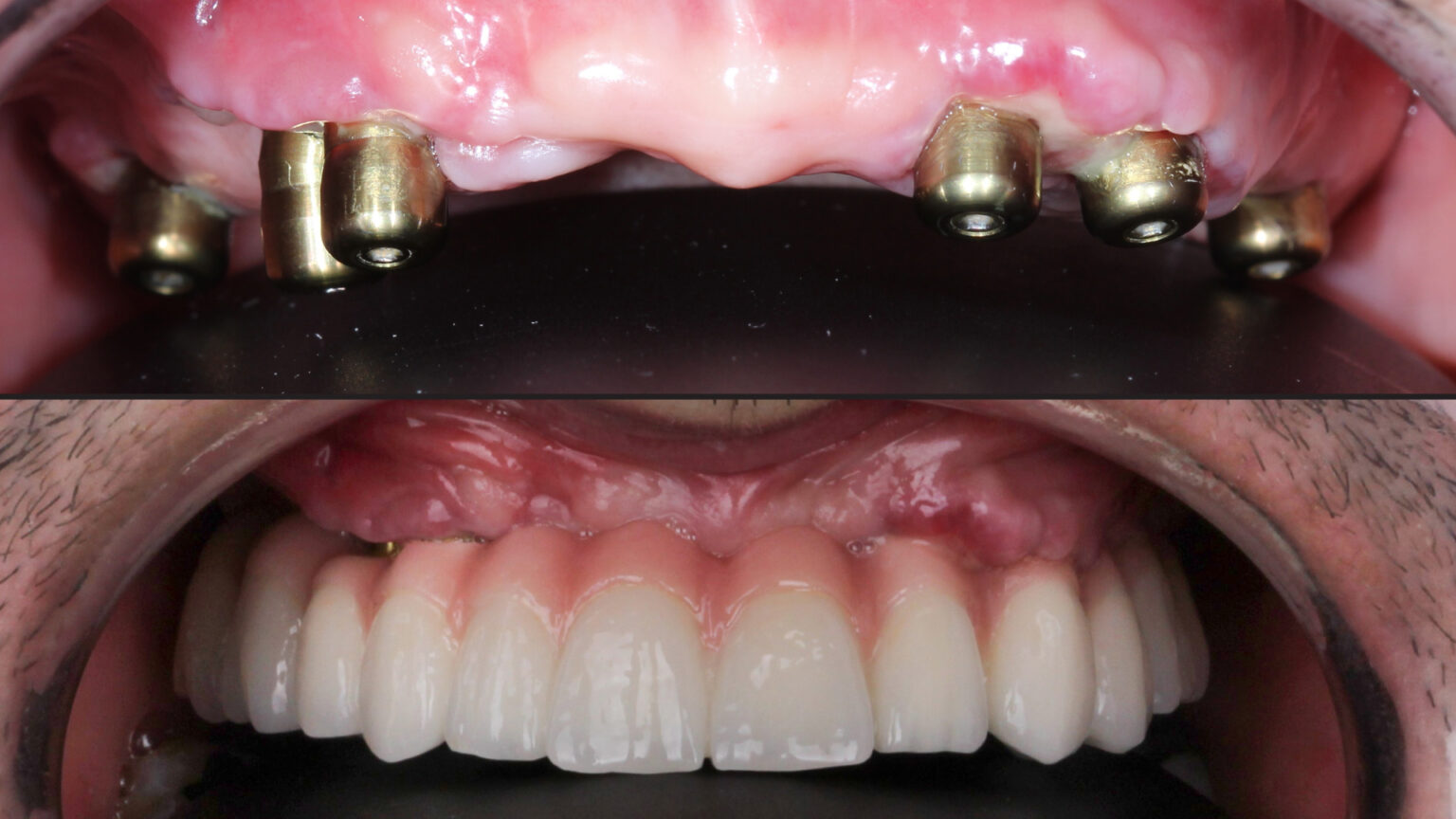 Implant dentaire risques quels sont le risques et complications — free download