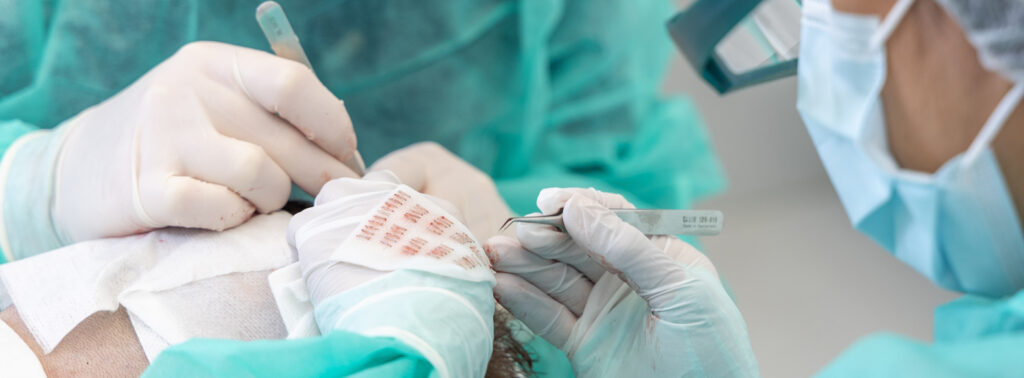 greffons-greffe-cheveux