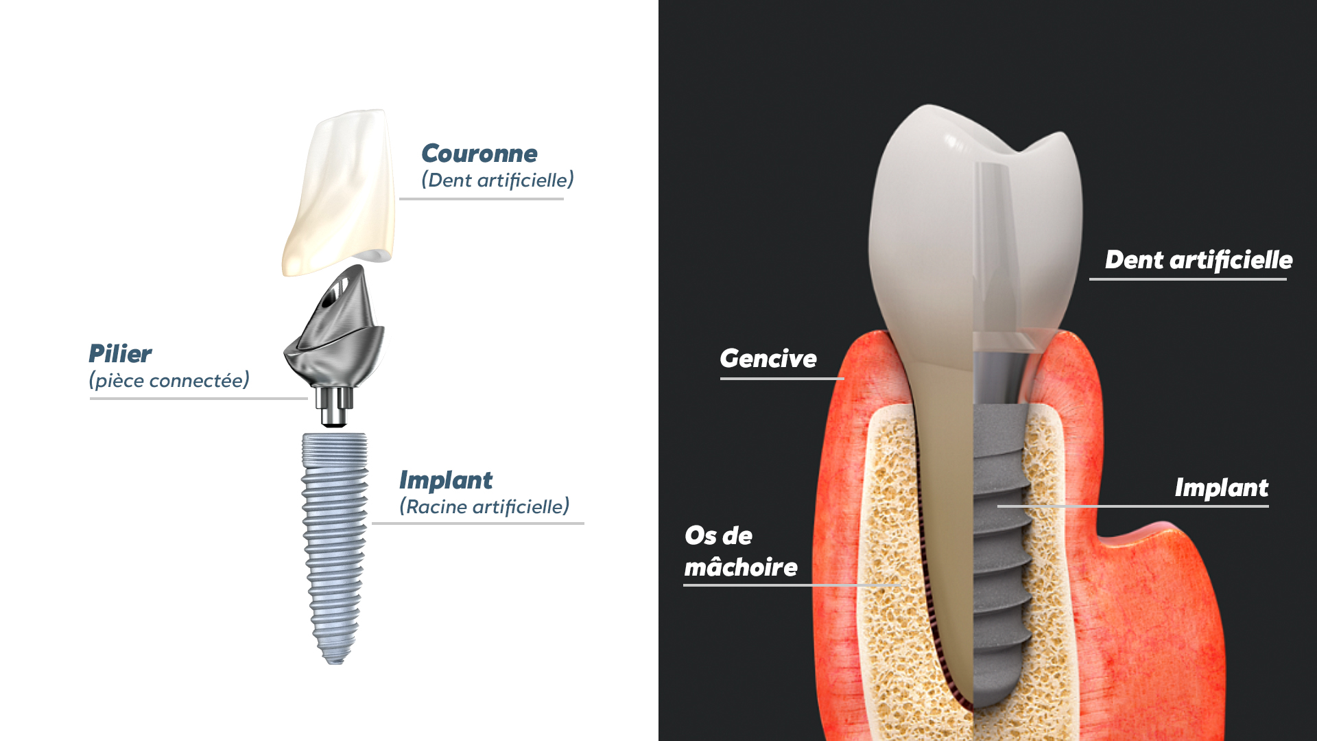 Schéma légendé d'un implant dentaire : la couronne, le pilier et l'implant en titane, puis une coupe montrant l'implant dans l'os de la mâchoire sous la gencive