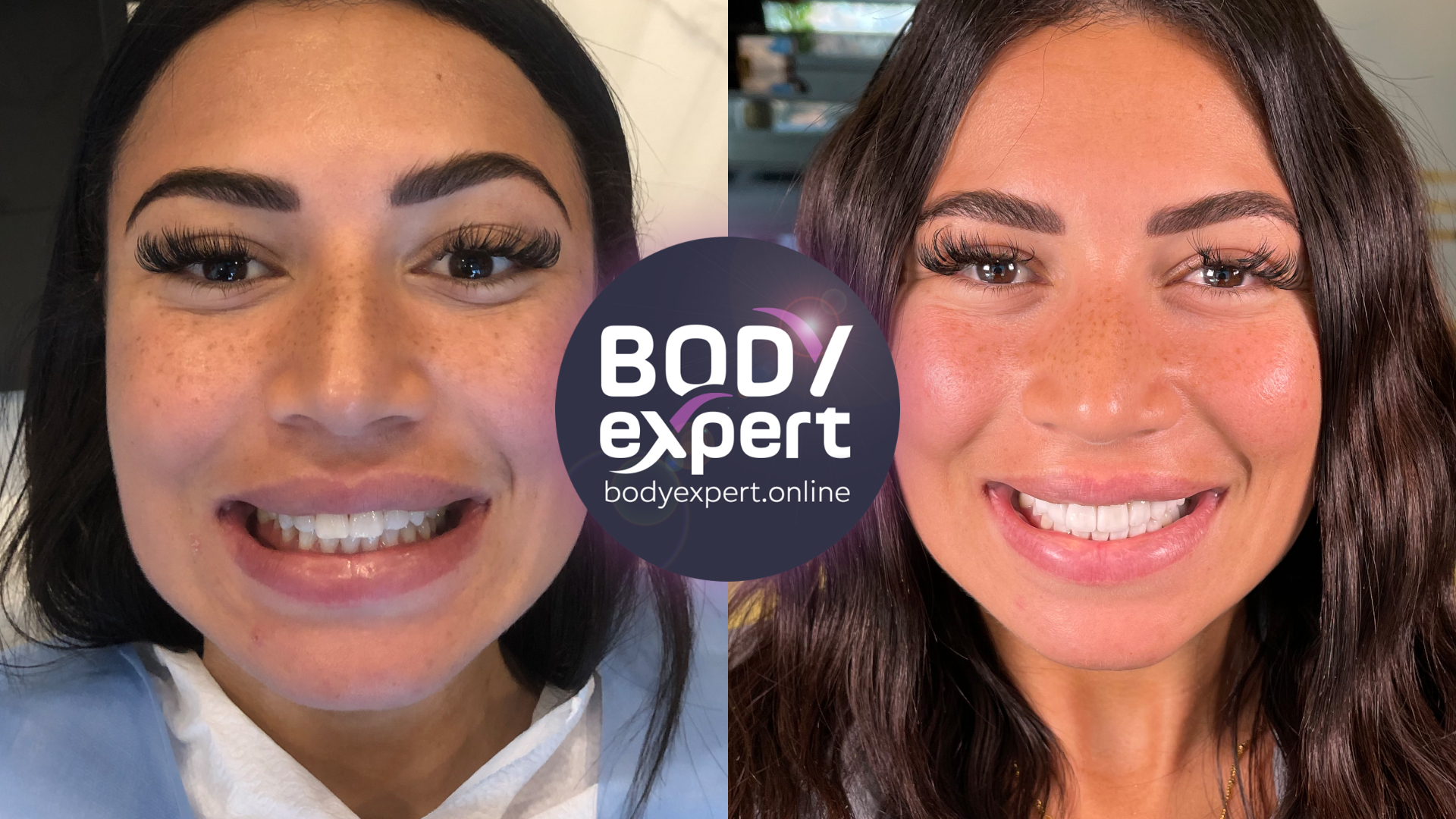 Before and after photographs of a dark-haired female patient: uneven, yellowed upper teeth, then a regular, lighter row