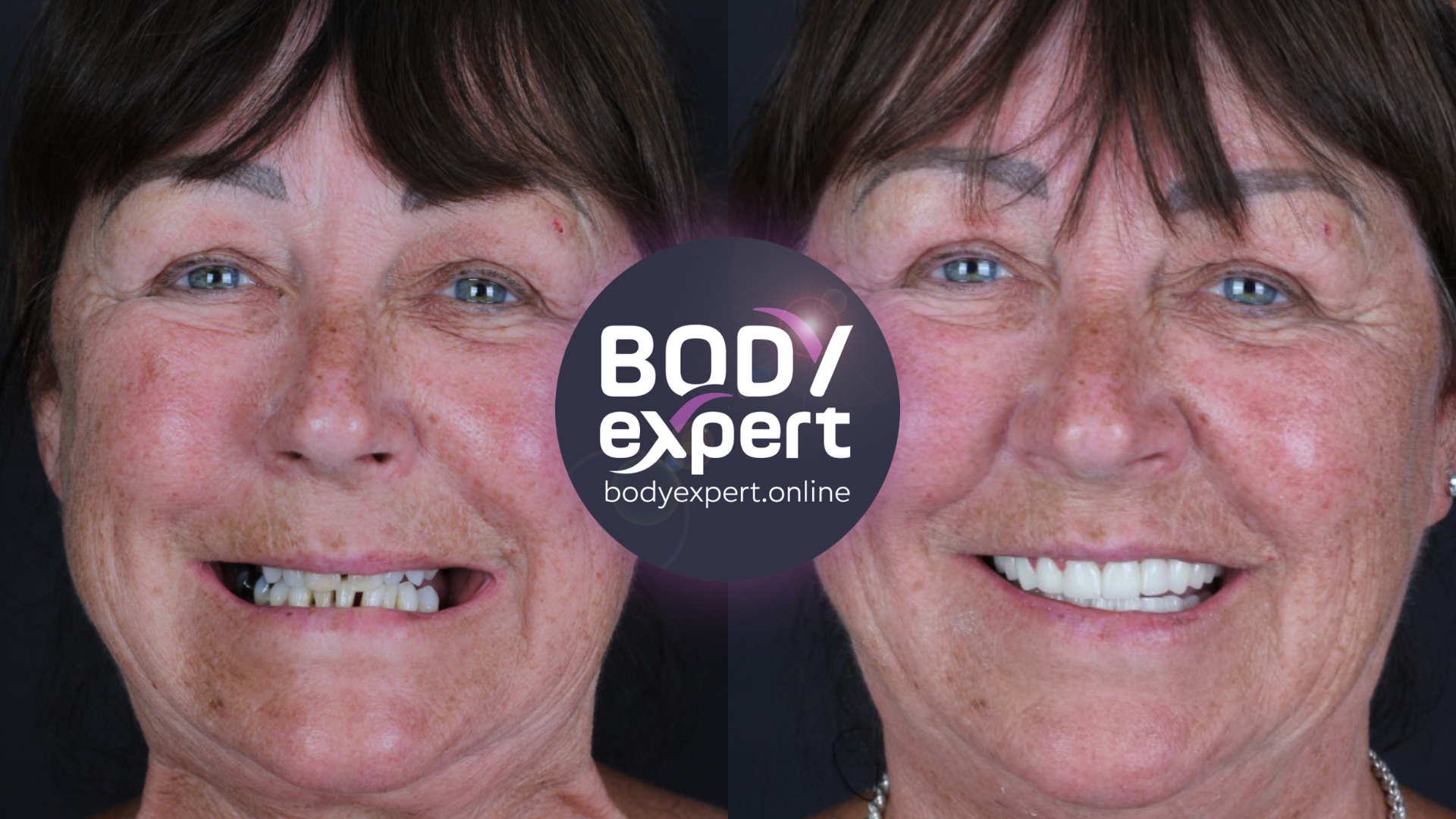 Before-and-after comparison of a patient's smile, image branded Body Expert