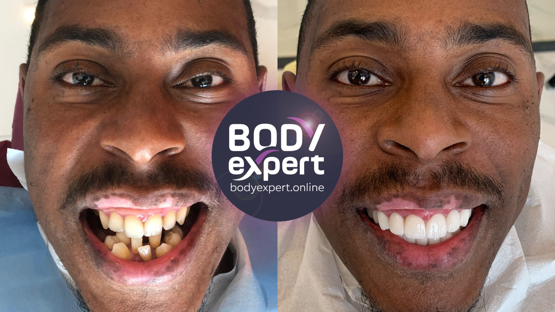 Before and after photographs of a male patient with a moustache: badly damaged and receding front teeth, then a complete, even row