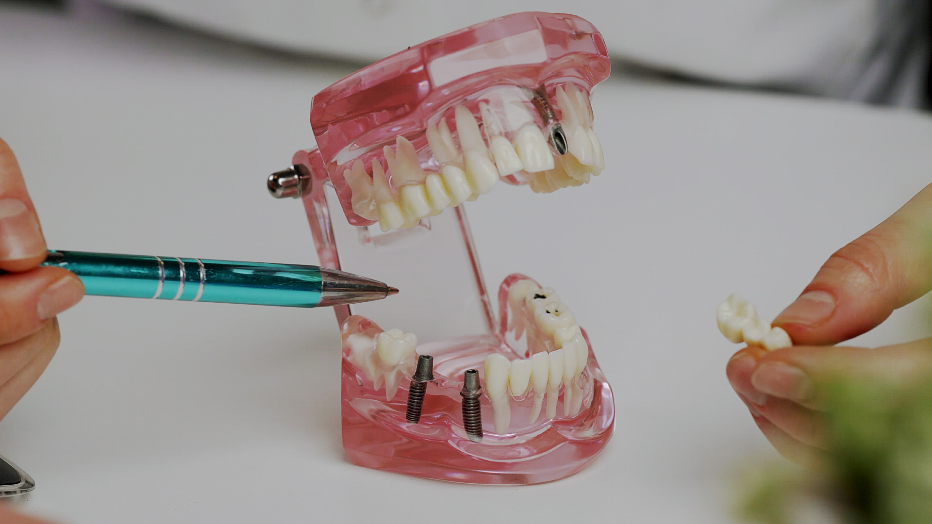 Modèle pédagogique de mâchoire en résine transparente équipé d'implants, présenté à l'aide d'une sonde