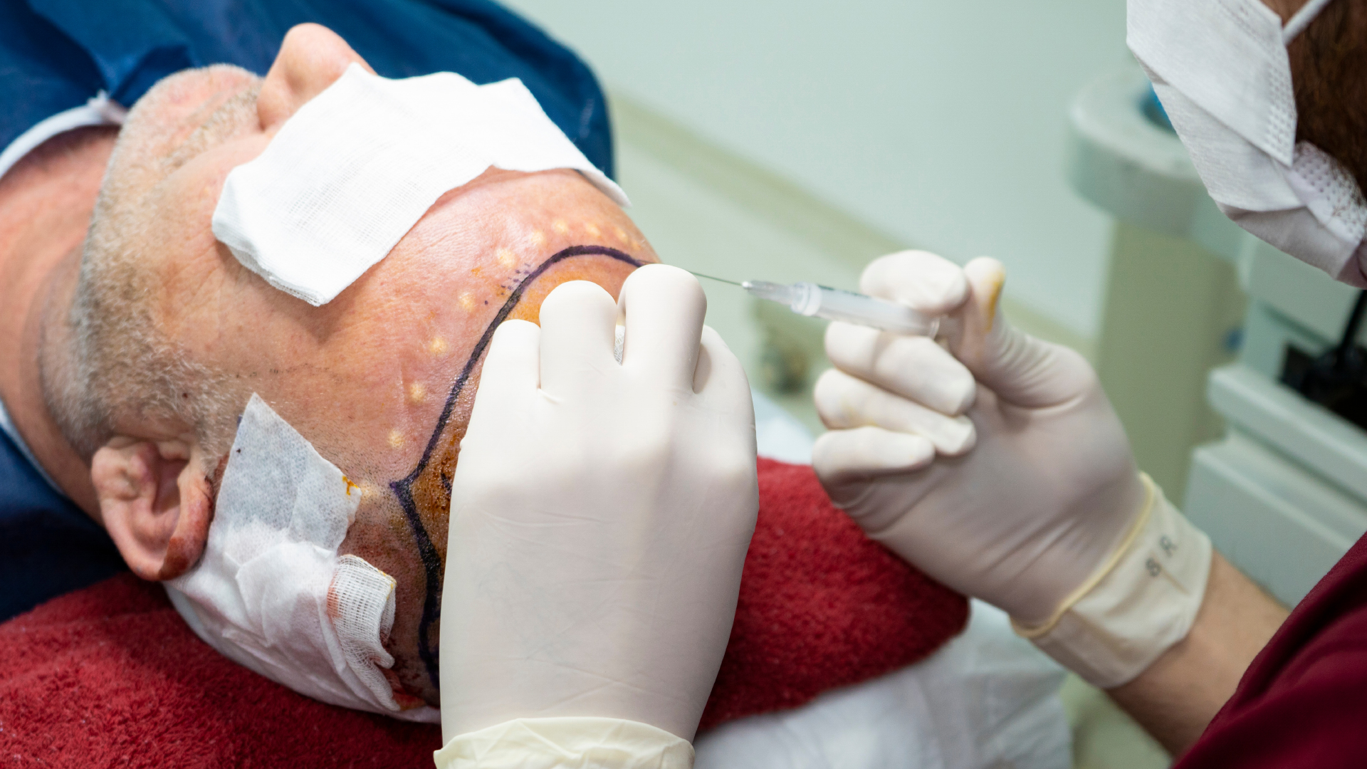 Local anaesthetic being injected into a patient's scalp, the recipient area marked out in pen