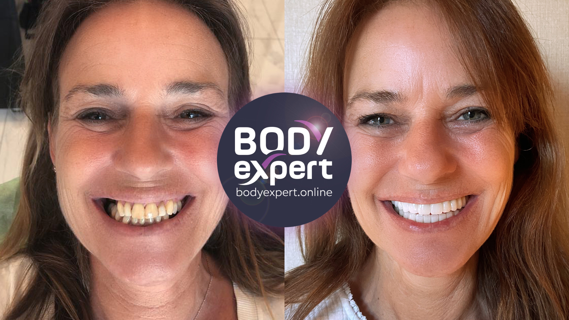Before and after photographs of a female patient with reddish-brown hair: worn, yellowed teeth, then a regular, bright smile